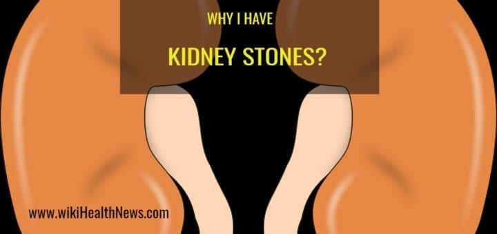 kidney stones