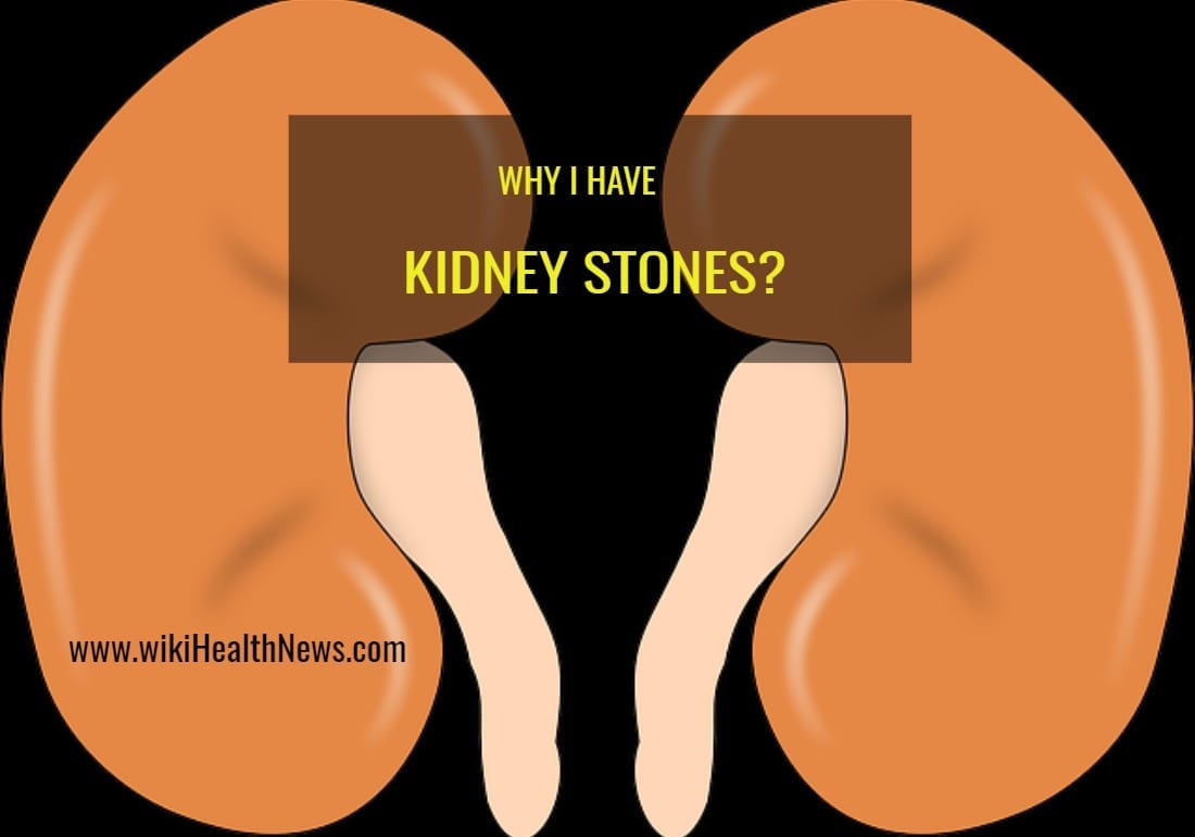 kidney stones