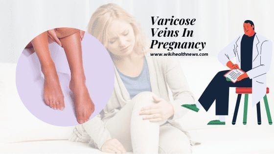 Varicose veins