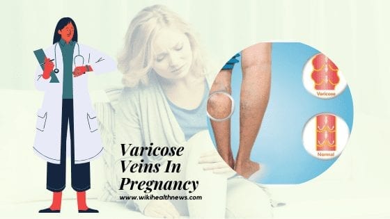 Varicose veins in pregnancy