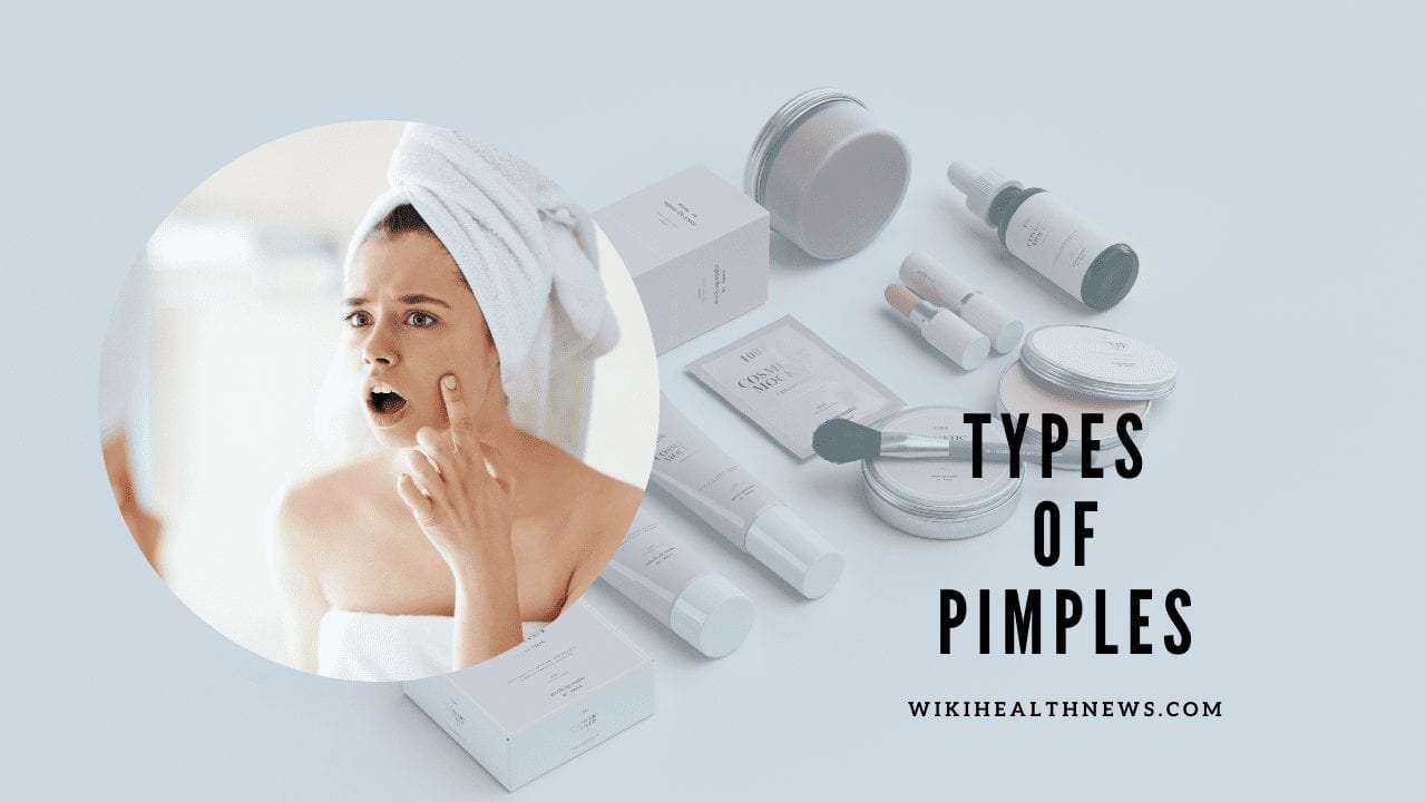 Types of Pimples