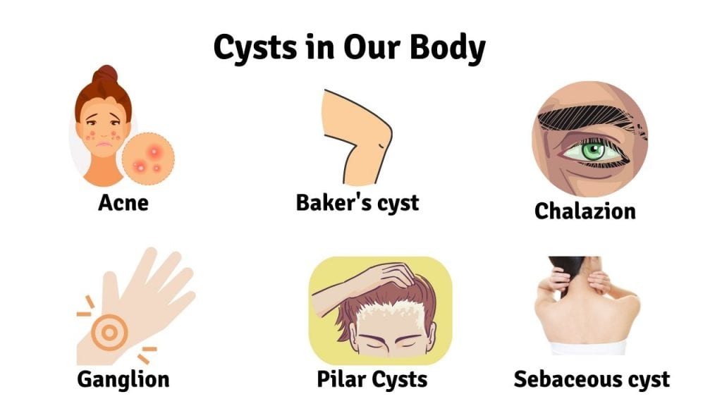 Cysts in our body 