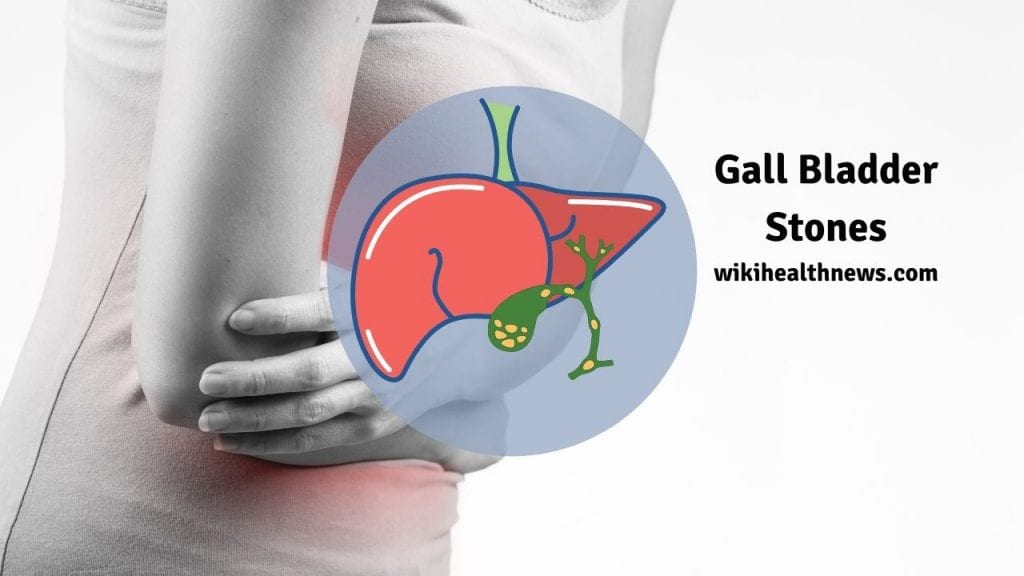 Gall bladder stones 