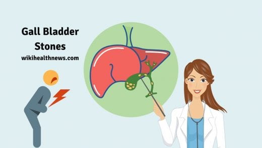 Gall bladder stones