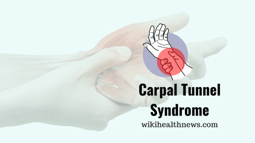 Carpal Tunnel Syndrome